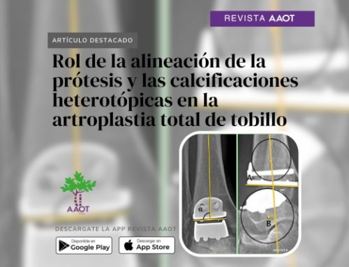 Artículos destacados – Rol de la alineación de la prótesis y las calcificaciones heterotópicas en la artroplastia total de tobillo